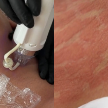 Мікроігольчастий RF-ліфтинг
                    Косметолог Дарья Одесса