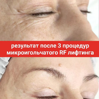 Мікроігольчастий RF-ліфтинг
                    Косметолог Дарья Одесса