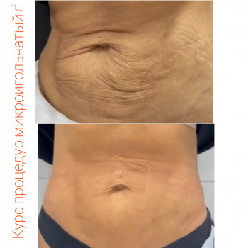 Мікроігольчастий RF-ліфтинг
                    Косметолог Дарья Одесса