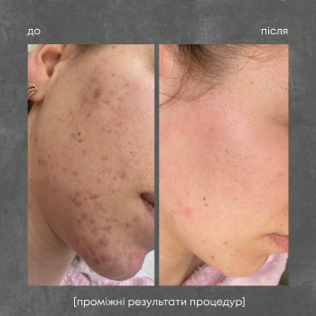 ipl фотоомоложение
                    Косметолог Дарья Одесса