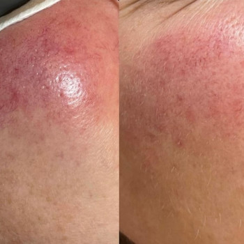 ipl фотоомоложение
                    Косметолог Дарья Одесса