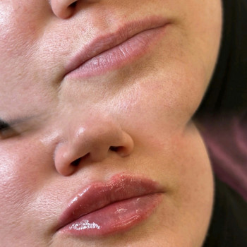 Увеличение губ