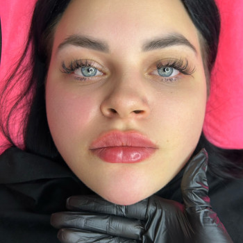 Контурная пластика губ и подбородка