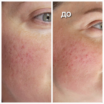 Біоревіталізація
                    Косметолог-ін'єкціоніст Марьяна Фастів