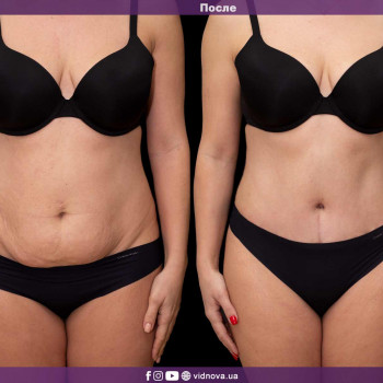 Фото з портфоліо фахівця Світлана Работенко (пластичний хірург, Львів)