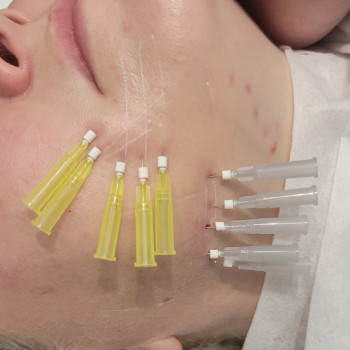 Тредліфтинг нитками, біоармування
                    Косметолог-ін'єкціоніст Марьяна Фастів