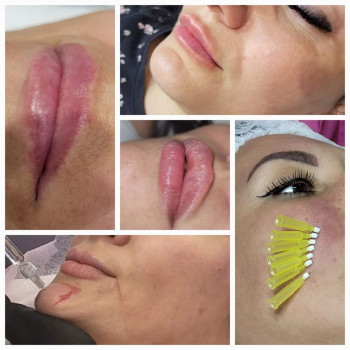 Тредліфтинг нитками, біоармування
                    Косметолог-ін'єкціоніст Марьяна Фастів