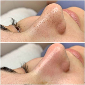 Комбінована чистка обличчя
                    Косметолог-ін'єкціоніст Марьяна Фастів