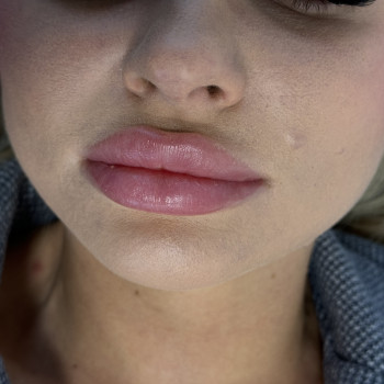 Загоєні губи