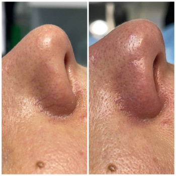 Видалення судинної сітки на крилах носа.