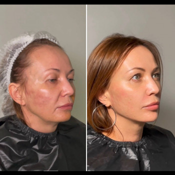 Нитевой лифтинг