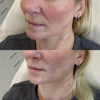 Контурная пластика носогубных складок