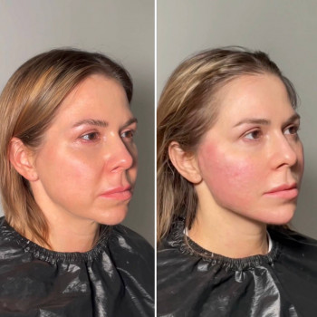 Нитевой лифтинг