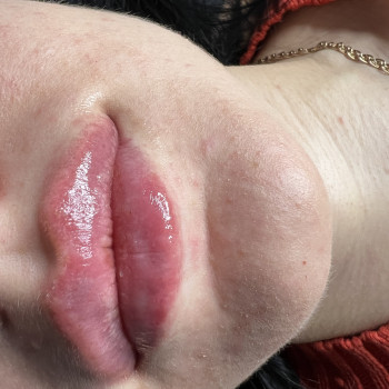 Контурна пластика губ