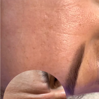 Ботулінотерапія міжбрівка