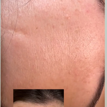 Ботулінотерапіяя лоб+ міжбрівка