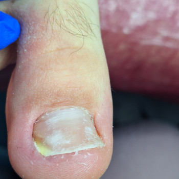 Ми закінчили роботу по відновленню нігтя після вростання