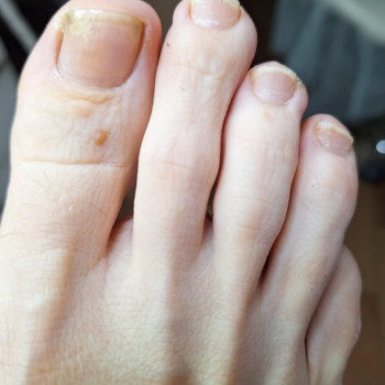 А це кінцевий результат. Ніготь е, грибів не виявлено. Кліет задоволений