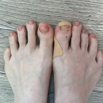 Ніготь не ріс, був деформований. Аналіз вказав на грибкове ураження, але ми зробили відеовлення за 4...