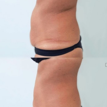 Результат до та після 1 процедури Віскі обгортання