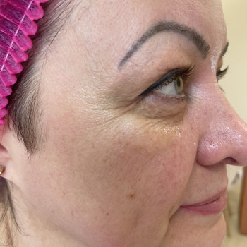 Ботокс
                    Врач-косметолог Олена Львов