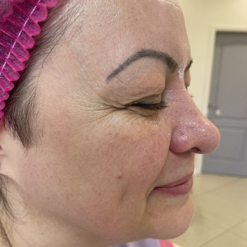 Ботокс
                    Врач-косметолог Олена Львов