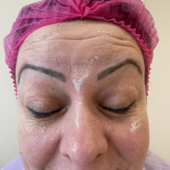 Ботокс
                    Врач-косметолог Олена Львов