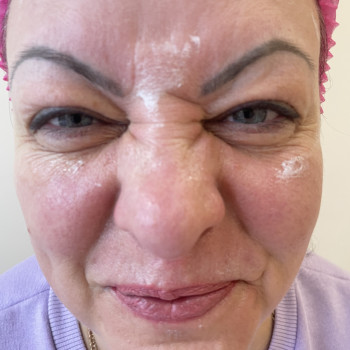 Ботокс
                    Врач-косметолог Олена Львов