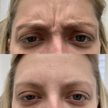 Ботокс
                    Врач-косметолог Олена Львов