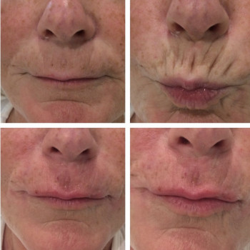 Кисетні сморшки філер+ ботокс 10 одиниць