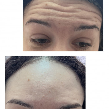 Ботулінотерапія
                    Косметолог-инъекционист Світлана Каменец-Подольский