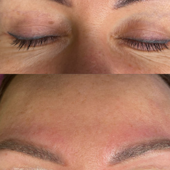 Лазерне видалення  неякісно татуажу та тату
                    Майстер перманентного макіяжу Ганна Київ