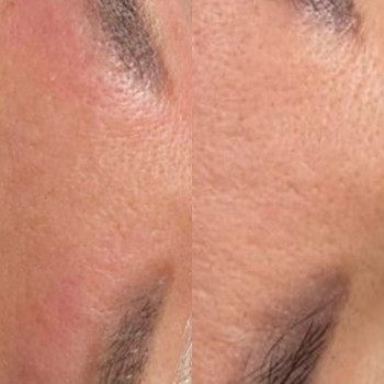 Лазерне видалення  неякісно татуажу та тату
                    Майстер перманентного макіяжу Ганна Київ