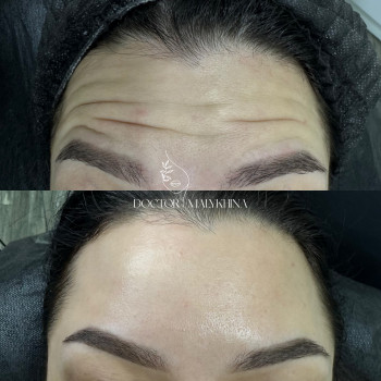 Ботокс
                    Врач-косметолог Ирина Краматорск