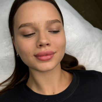 Збільшення губ
                    Косметолог Анна Вінниця