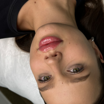 Збільшення губ
                    Косметолог Анна Вінниця