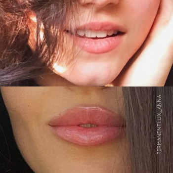 Збільшення губ
                    Косметолог Анна Вінниця