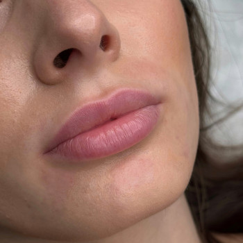 Збільшення губ
                    Косметолог Анна Вінниця