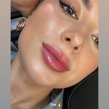 Збільшення губ
                    Косметолог Анна Вінниця