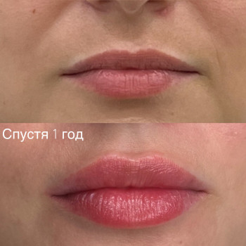 Збільшення губ
                    Косметолог Анна Вінниця
