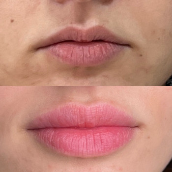 Збільшення губ
                    Косметолог Анна Вінниця