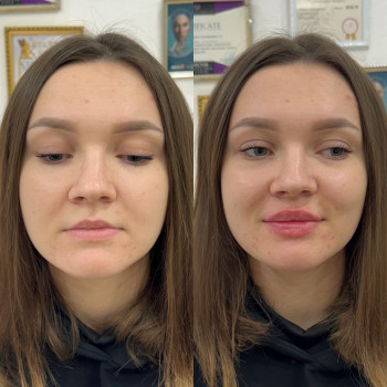 Збільшення губ
                    Косметолог Анна Вінниця