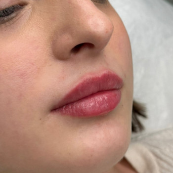 Збільшення губ
                    Косметолог Анна Вінниця