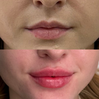 Збільшення губ
                    Косметолог Анна Вінниця