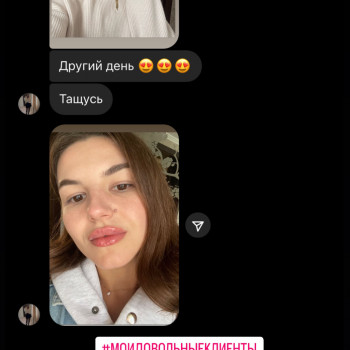 Збільшення губ
                    Косметолог Анна Вінниця