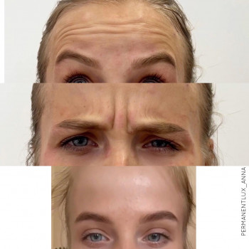 Збільшення губ
                    Косметолог Анна Вінниця