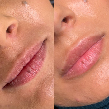 Збільшення губ
                    Косметолог Анна Вінниця