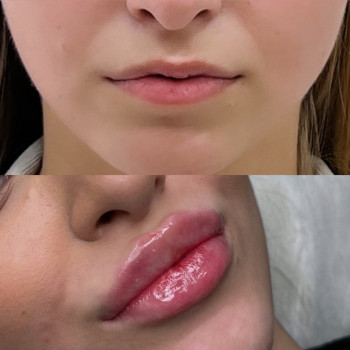 Збільшення губ
                    Косметолог Анна Вінниця