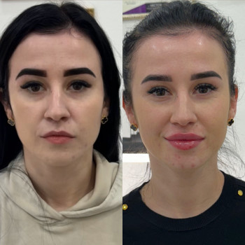 Збільшення губ
                    Косметолог Анна Вінниця