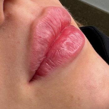 Збільшення губ
                    Косметолог Анна Вінниця